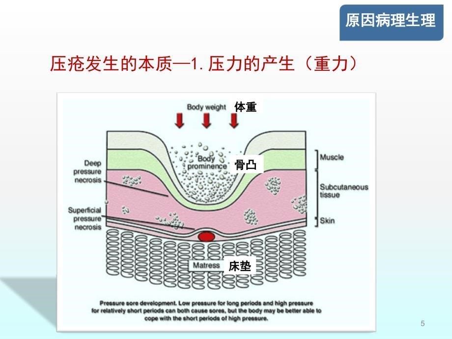 压疮创面处理ppt课件_第5页