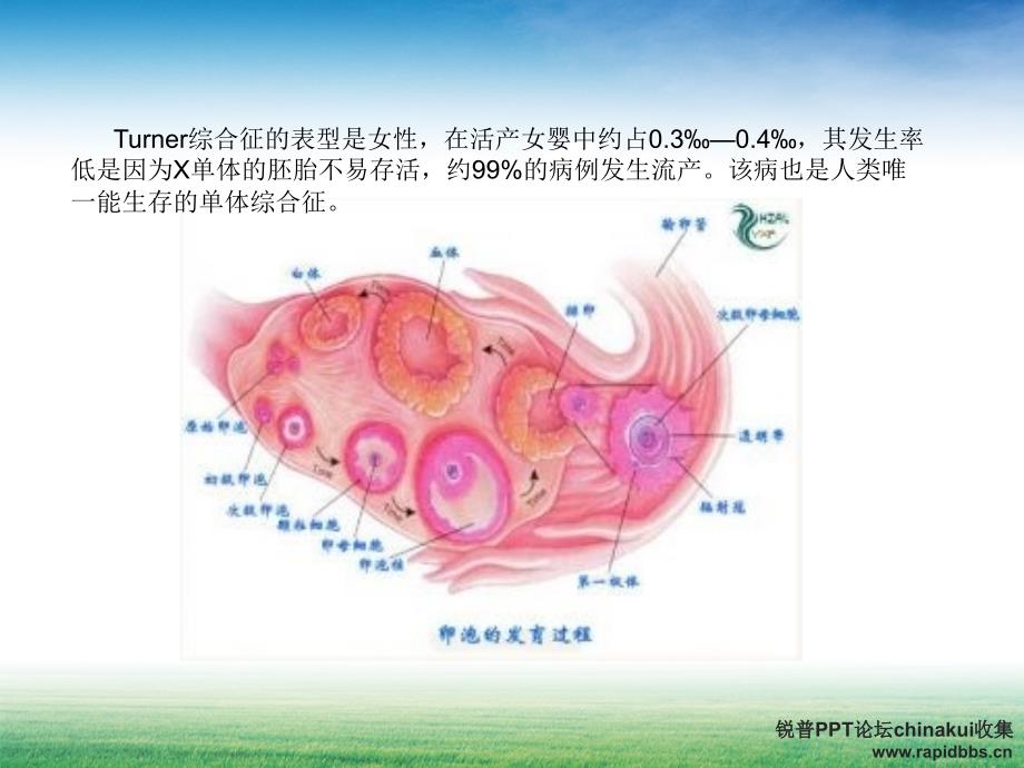 先天性卵巢发育不全综合征_第2页