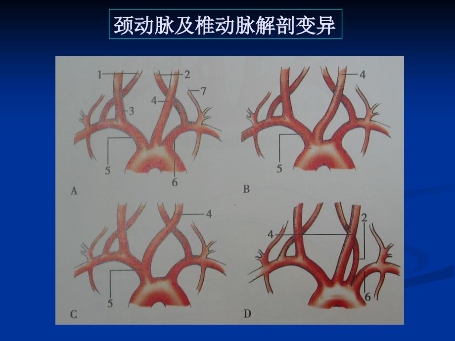 颈动脉疾病超声诊断_第3页