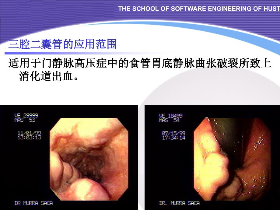 三腔二囊管的应用PPT课件_第2页