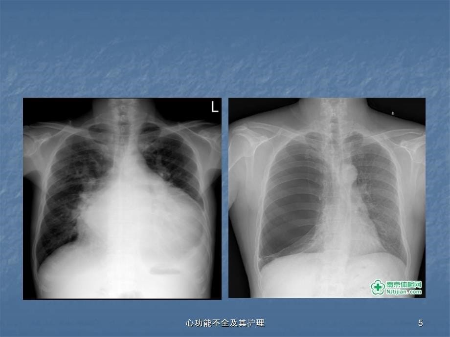 心功能不全及其护理课件_第5页