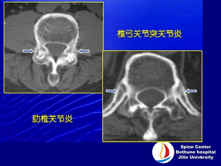 强直性脊柱炎刘理迪参考PPT_第5页