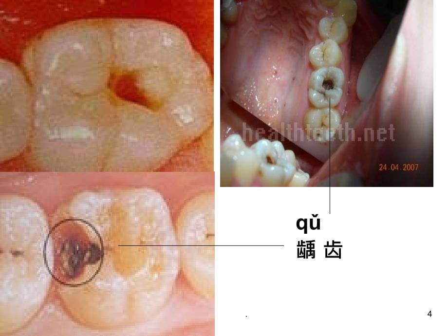 保护牙齿 预防龋齿PPT课件_第4页