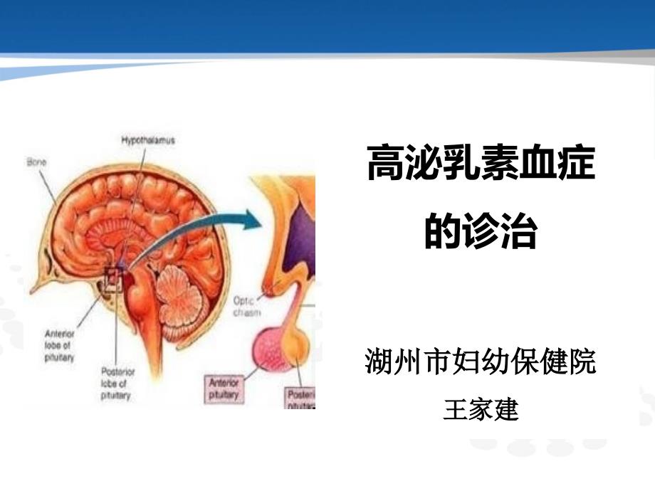 高泌乳素血症治疗_第1页