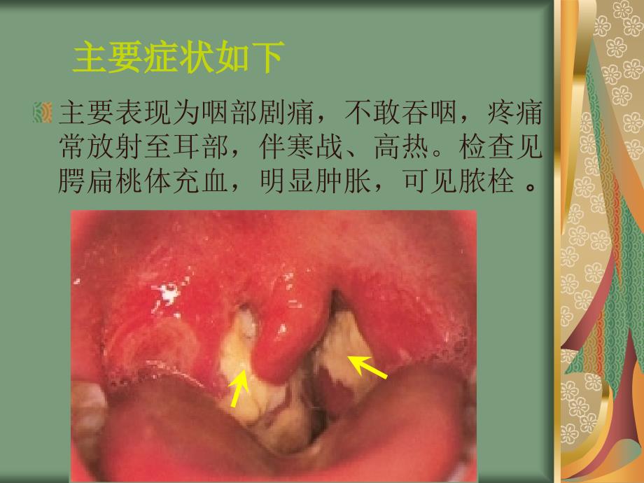 耳鼻喉科常见疾病讲座课件_第3页