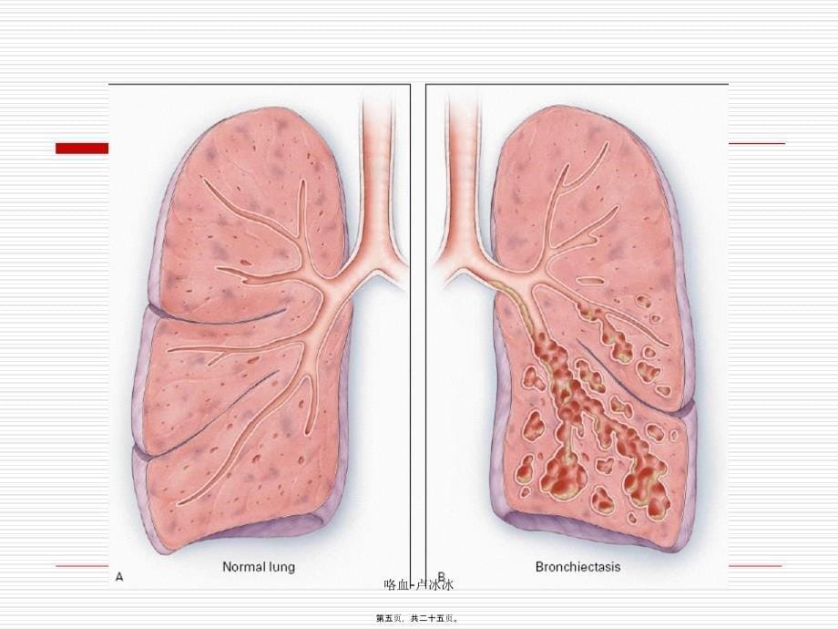 咯血-卢冰冰课件_第5页