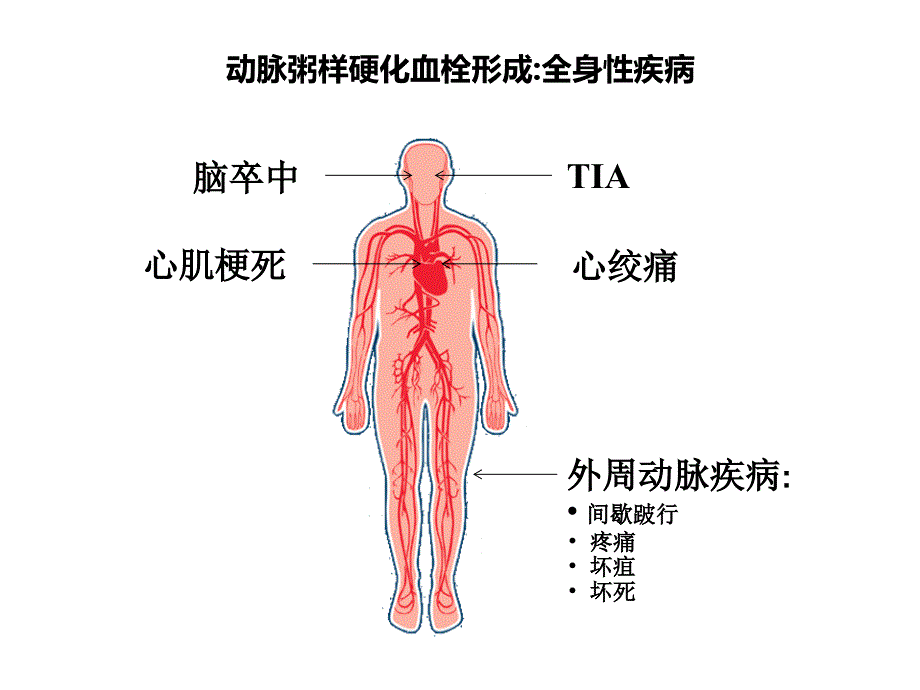 ASCVD时代总体心血管风险评估那点事儿-图文课件_第3页