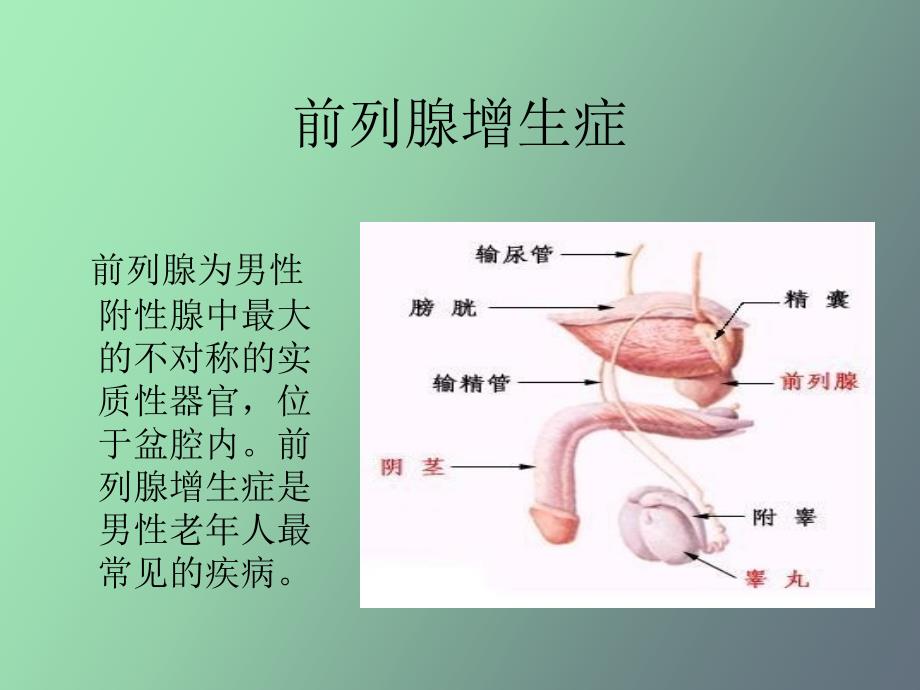 前列腺增生症_第2页