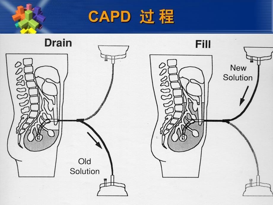 腹膜透析基本操作技术-精编_第5页