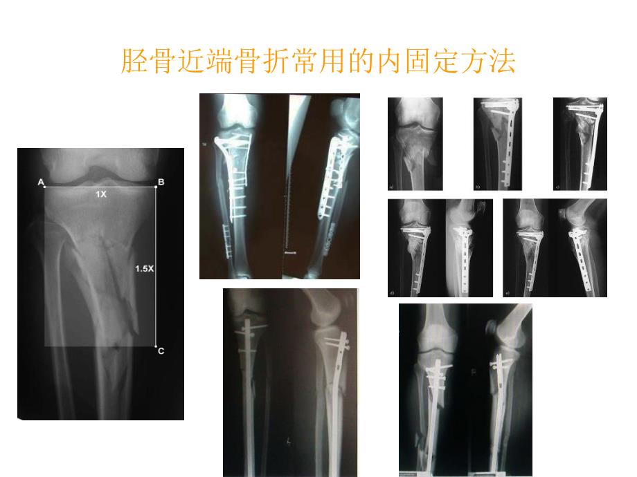 胫骨近端骨折治疗_第2页