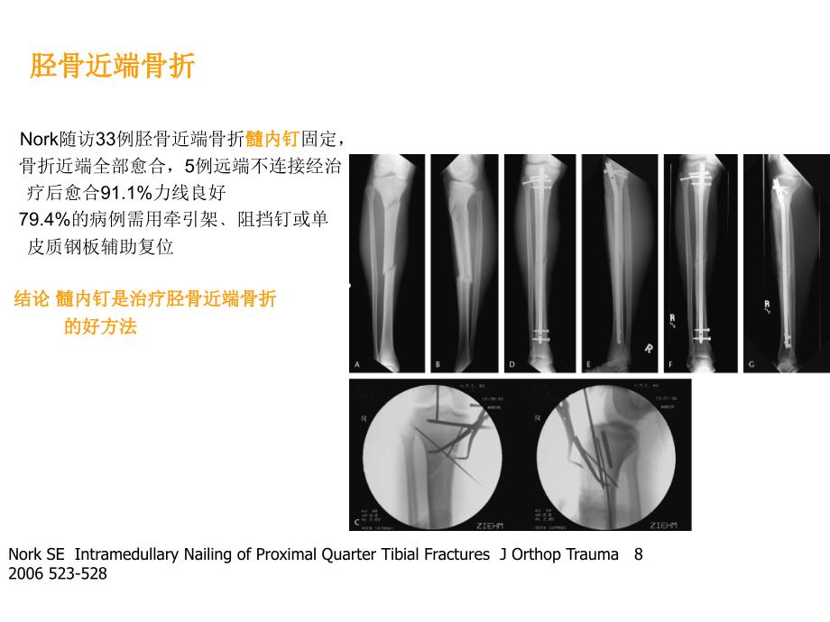 胫骨近端骨折治疗_第4页