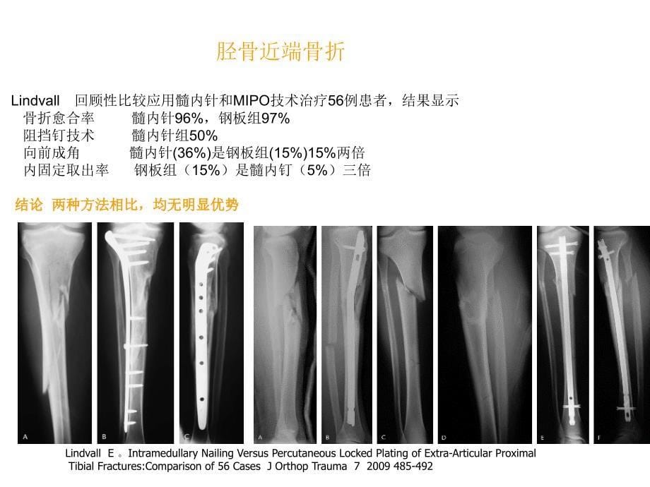 胫骨近端骨折治疗_第5页