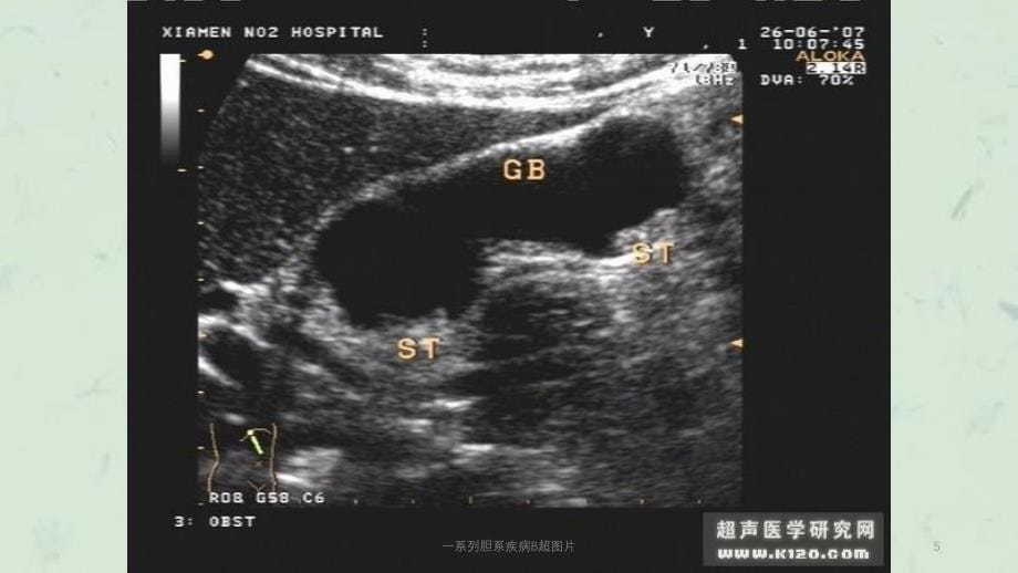 一系列胆系疾病B超图片课件_第5页