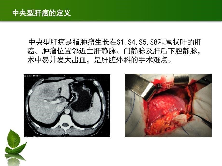 中央型肝癌的外科治疗_第5页