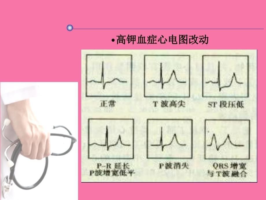 药物及电解质紊乱对心电图的影响ppt课件_第5页