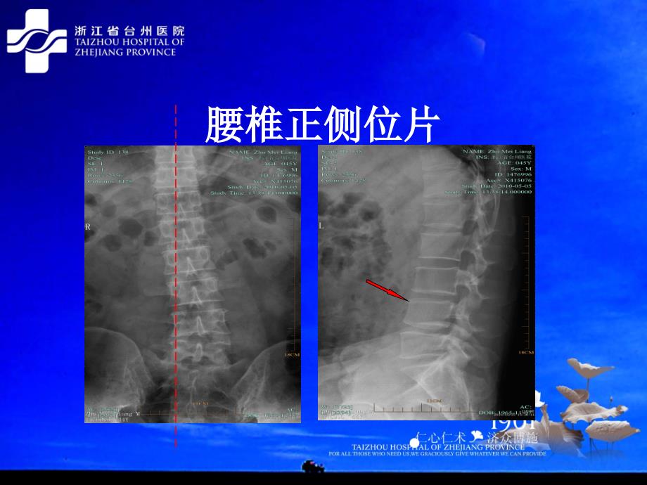 腰椎间盘突出症3_第4页