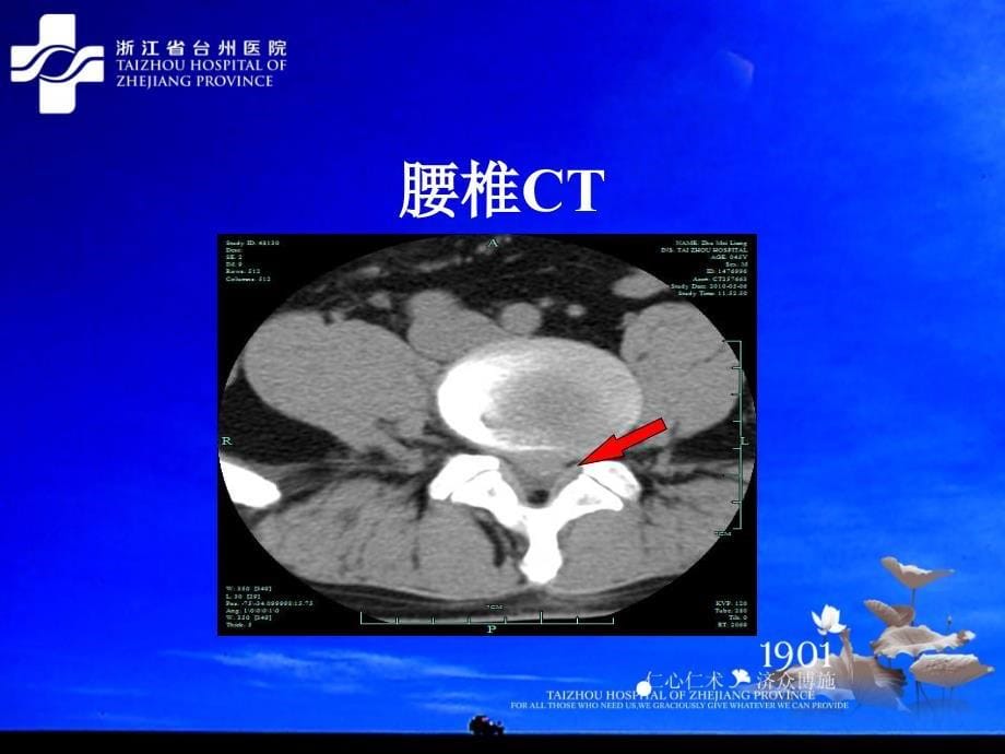 腰椎间盘突出症3_第5页