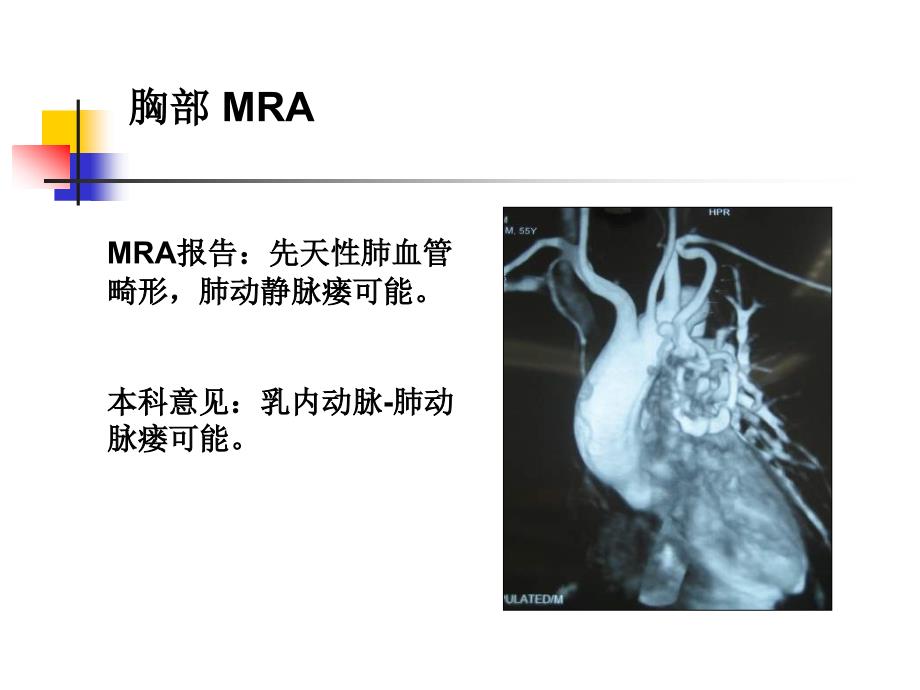 乳内动肺动脉瘘的介入治疗_第4页