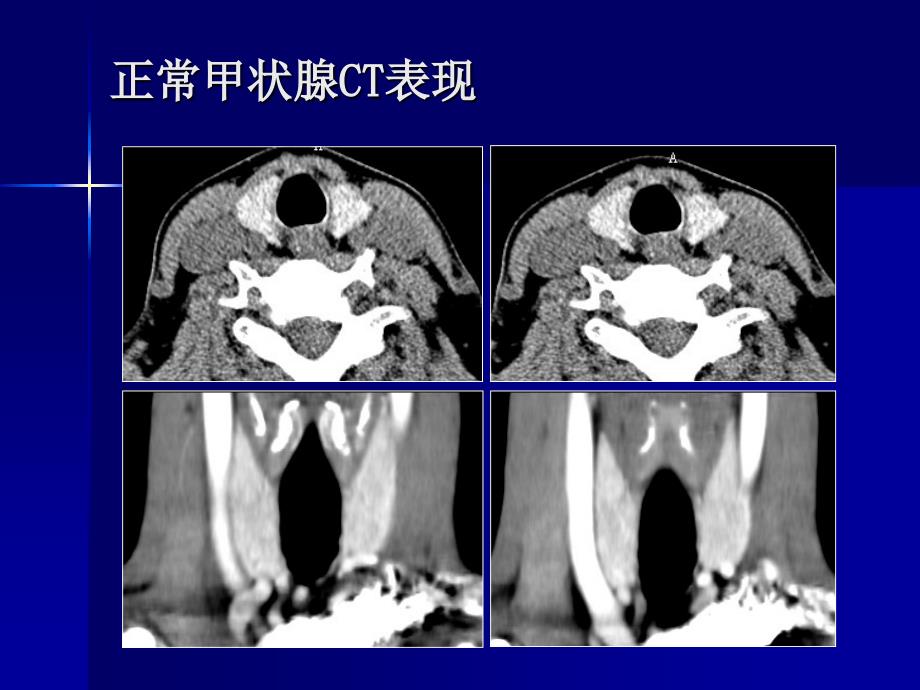 甲状腺疾病的CT诊断_第4页