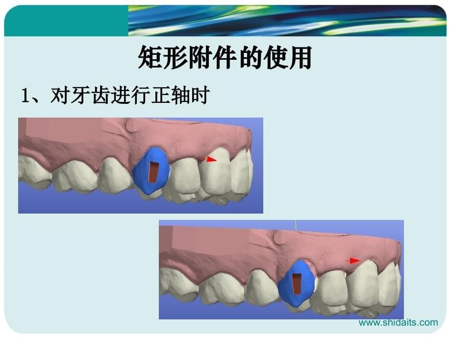 隐形矫治相关临床操作_第5页