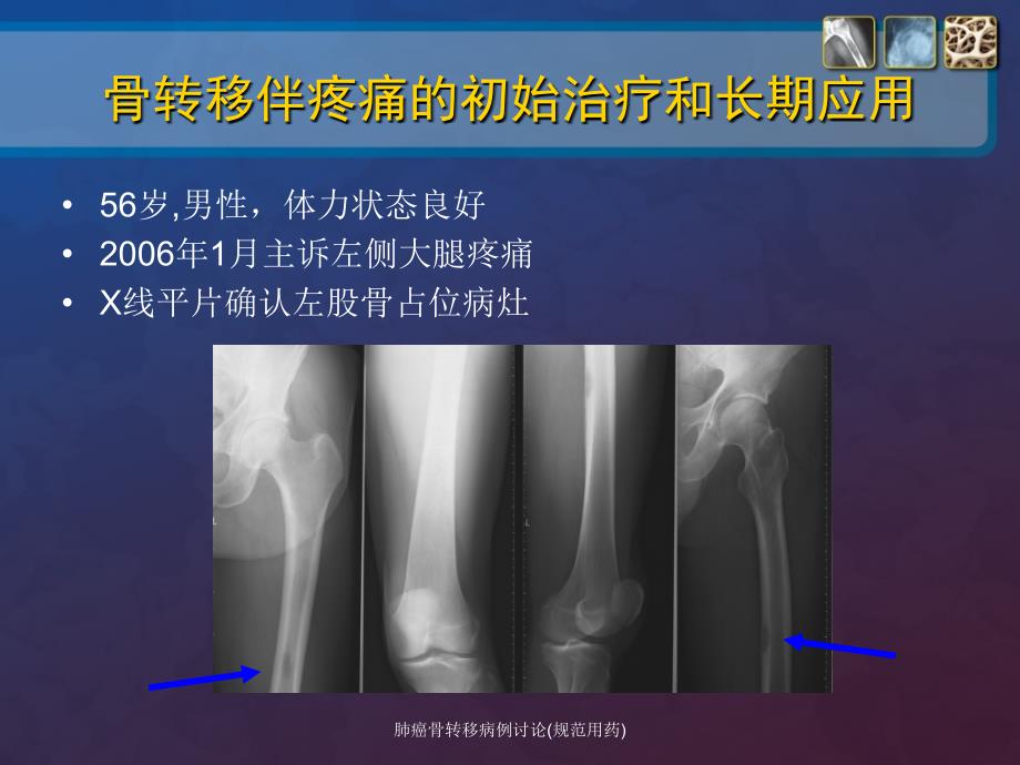 肺癌骨转移病例讨论规范用药课件_第2页