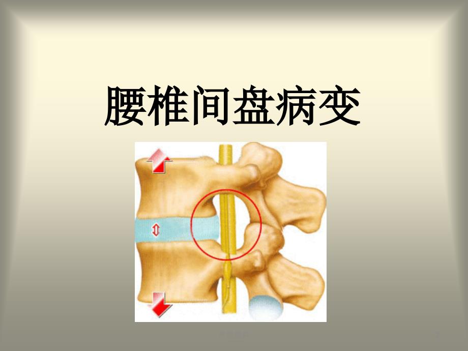 腰椎间盘病变的分型及影像学诊断（行业荟萃）_第2页