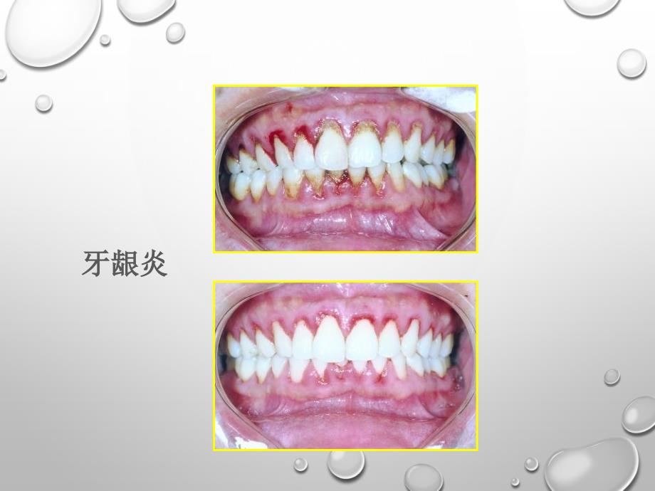 31 牙周病的病因《口腔预防医学》教学课件_第3页