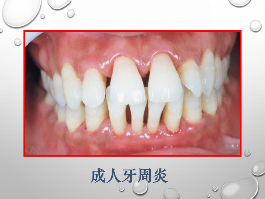 31 牙周病的病因《口腔预防医学》教学课件_第4页