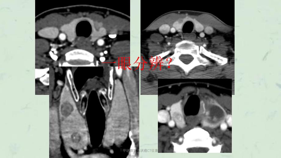 甲状腺乳头状癌CT征象课件_第1页