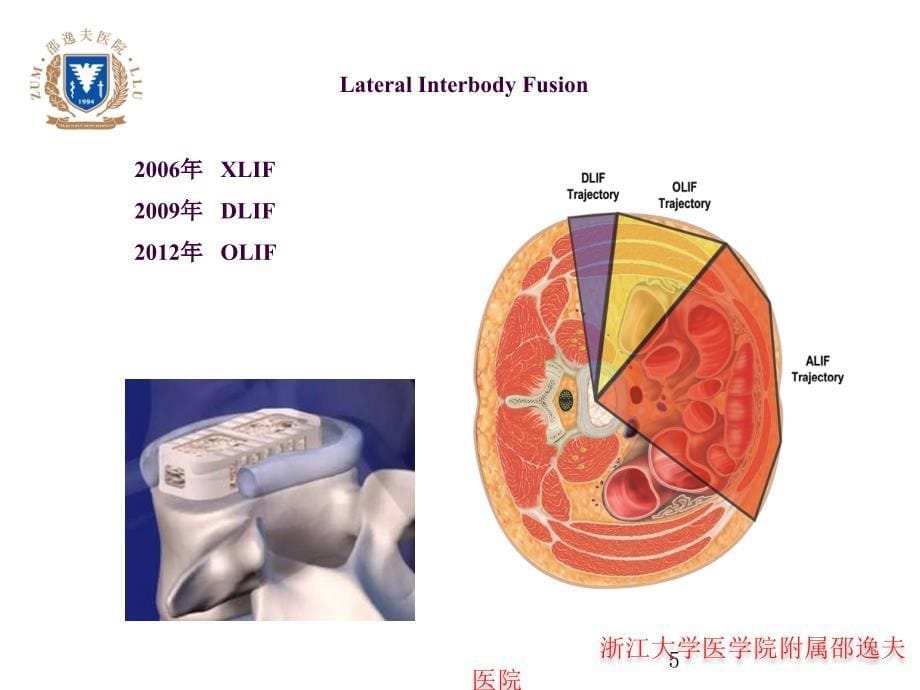 OLIF入路和相关解剖ppt课件_第5页