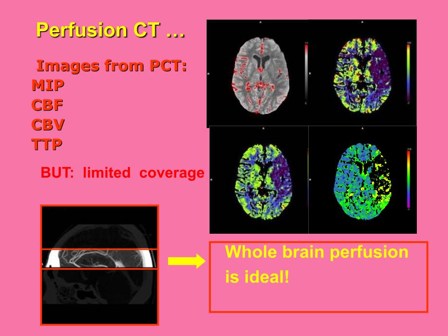 急性缺血性脑卒中的三维血流成像英文ppt课件_第3页