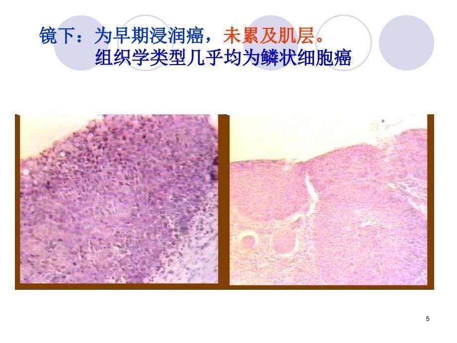 （优质课件）消化系统常见肿瘤(临床病理)_第5页