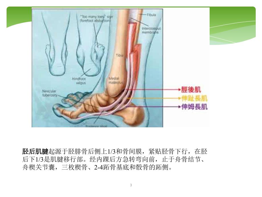 胫后肌腱功能不全的诊治ppt课件1_第3页