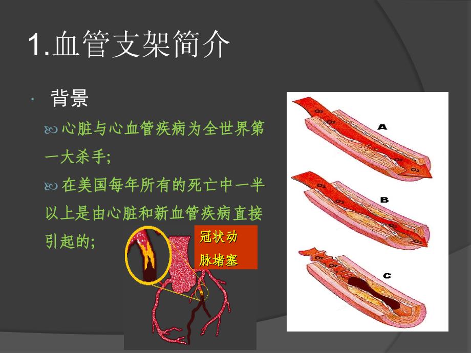 血管支架设计PPT课件_第3页