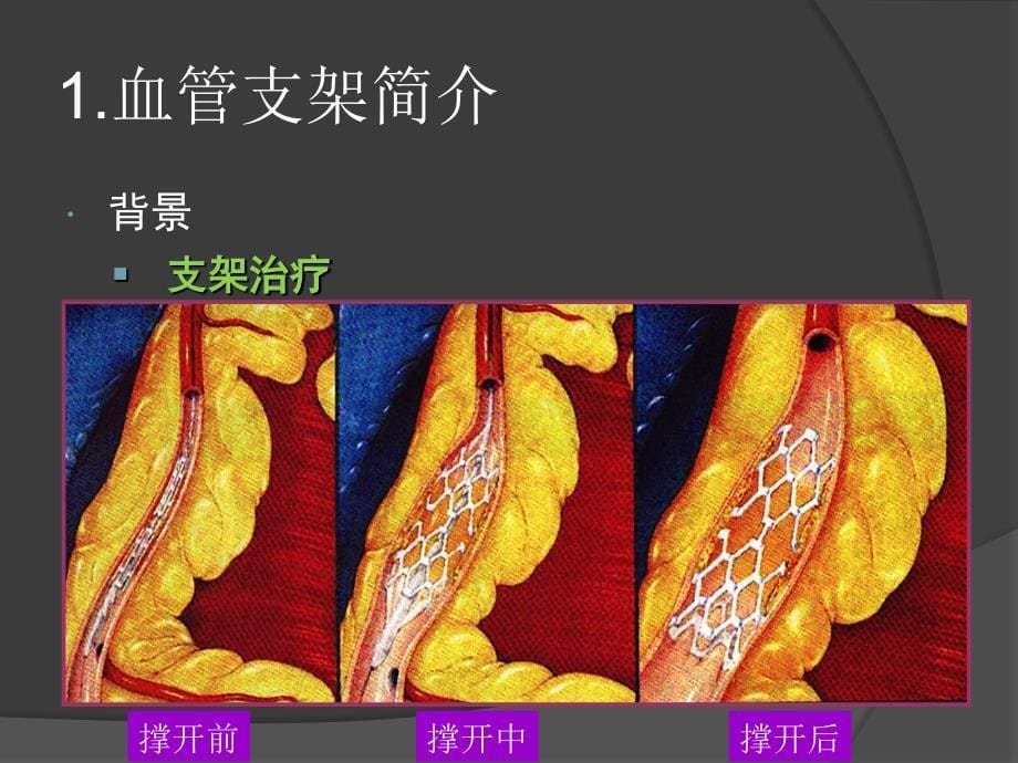 血管支架设计PPT课件_第5页