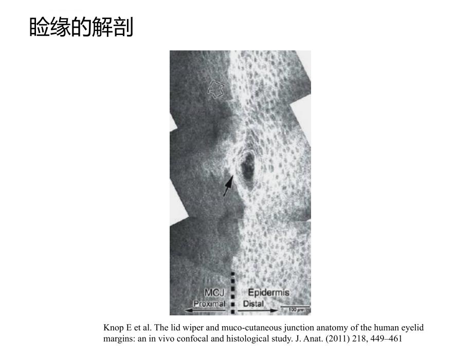 睑缘解剖和睑缘炎病理机理ppt课件_第4页