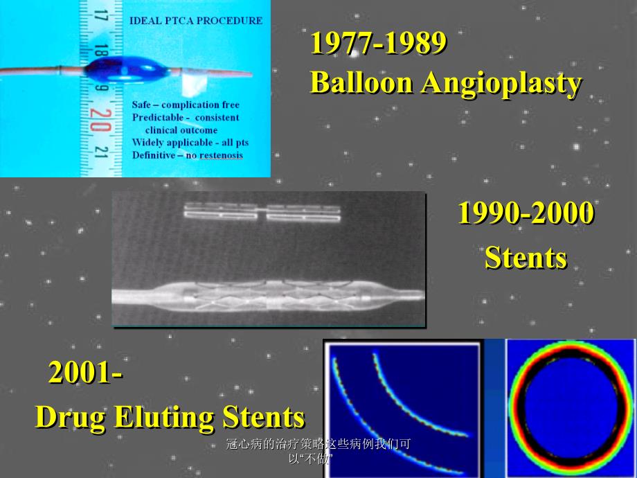 冠心病的治疗策略这些病例我们可以不做课件_第4页