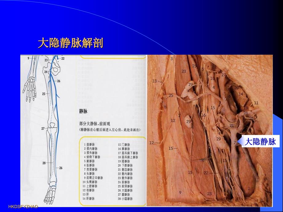 大隐静脉曲张治疗方法.ppt_第3页