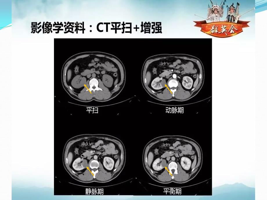 病理读片肾肿瘤群英会PPT课件_第4页