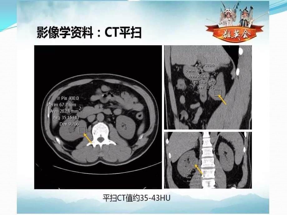 病理读片肾肿瘤群英会PPT课件_第5页