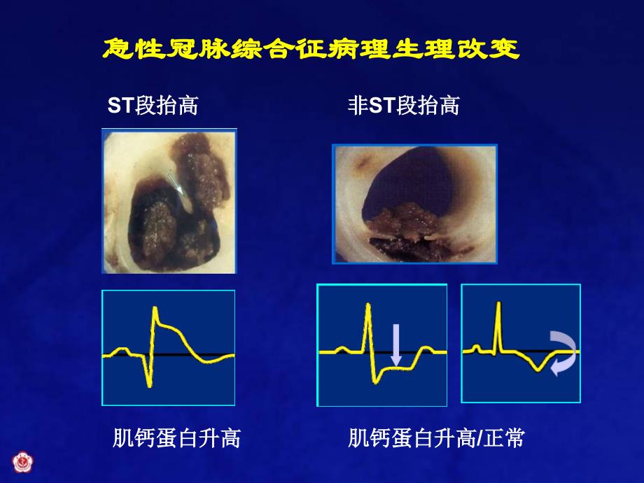 ACS更新指南中的抗栓治疗_第2页