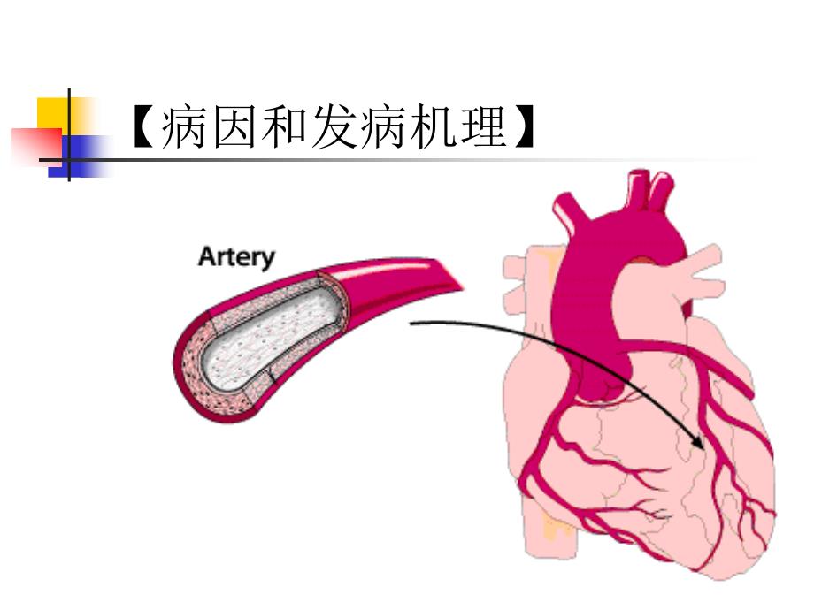 心肌梗死3学时文档资料_第3页