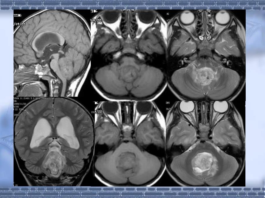 小儿头颅核磁PPT课件_第2页