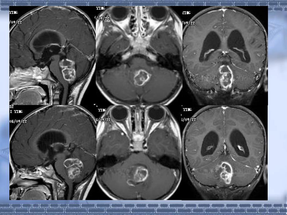 小儿头颅核磁PPT课件_第3页