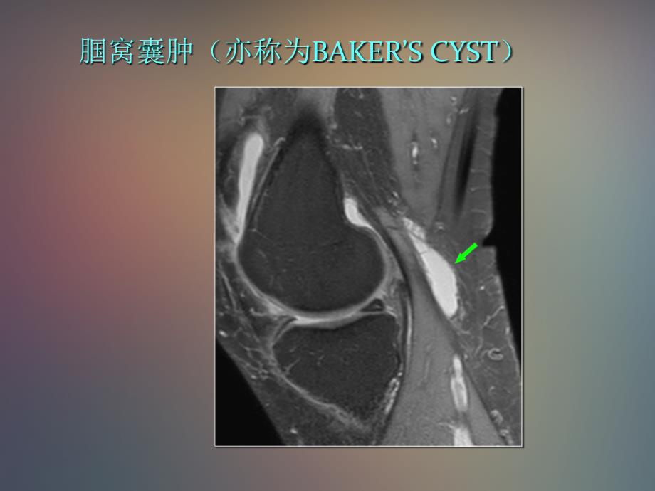 膝关节囊性损伤和滑膜病变ppt课件_第4页