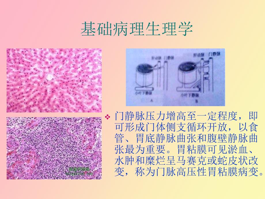 肝硬化合并上消化道出血的治疗与护理_第3页