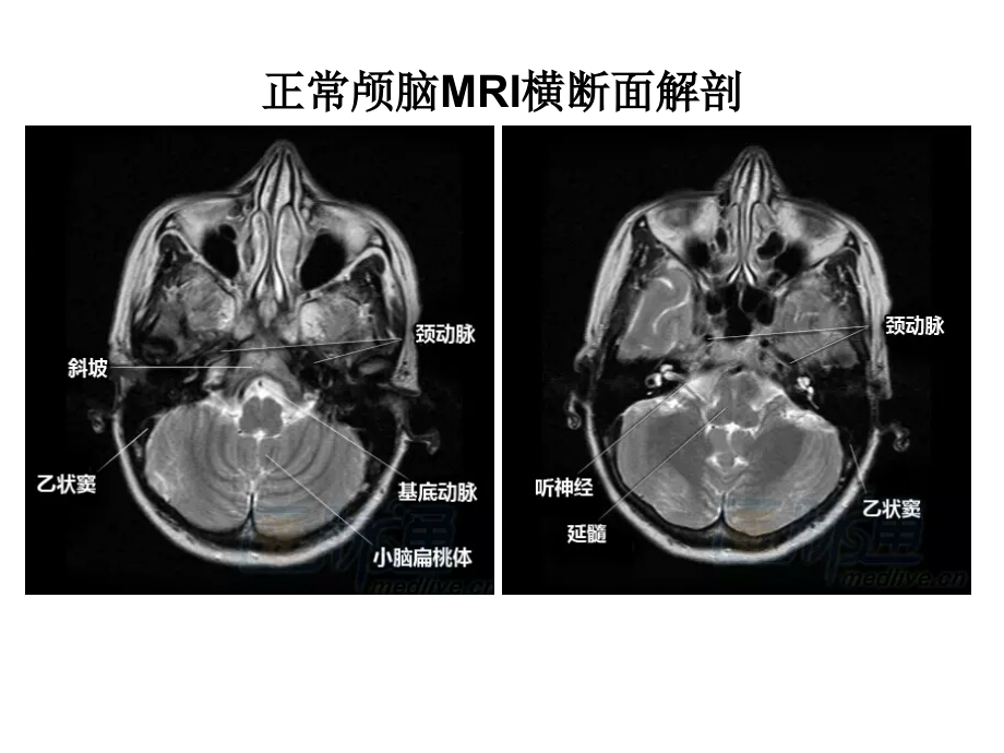 脑血管疾病的MRI诊断ppt课件_第4页