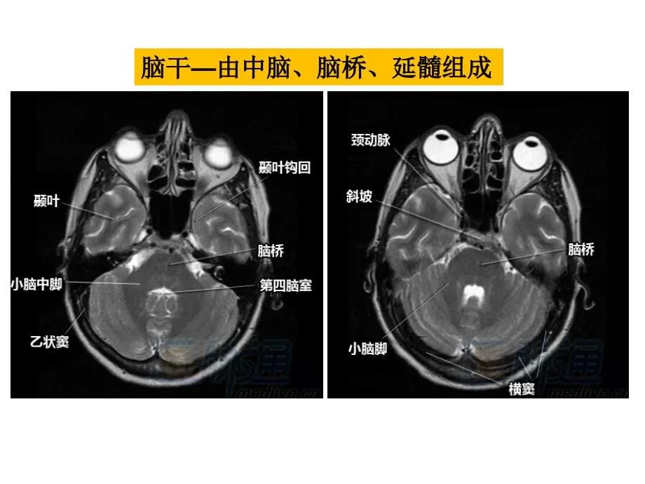 脑血管疾病的MRI诊断ppt课件_第5页