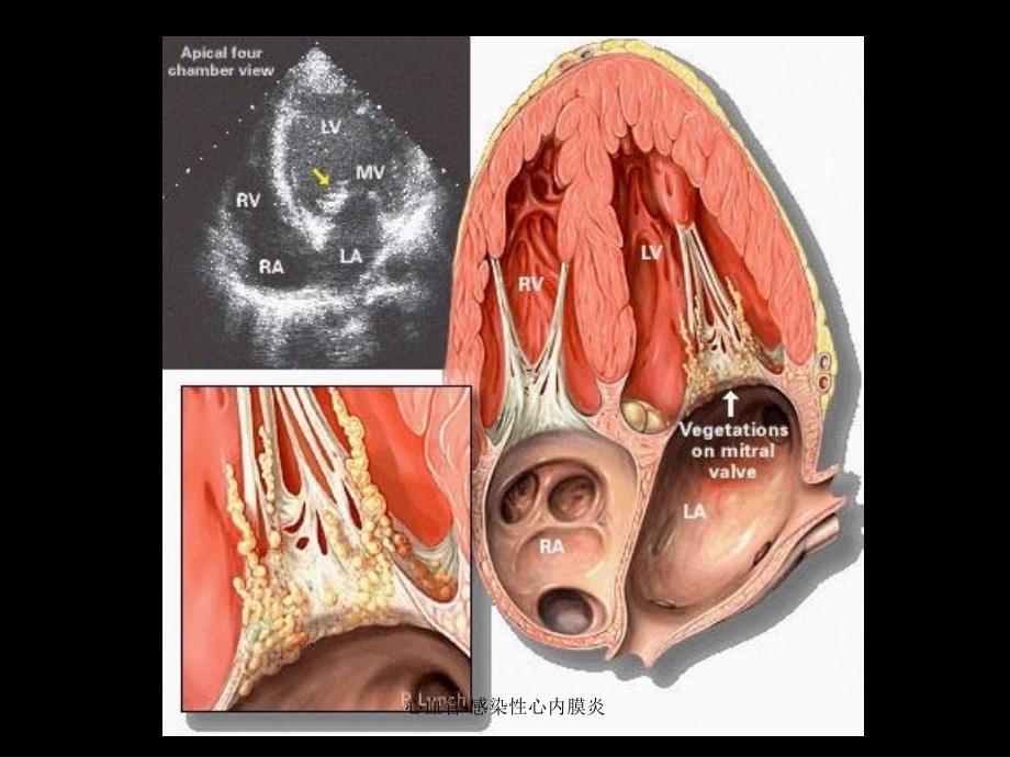 心血管感染性心内膜炎课件_第3页