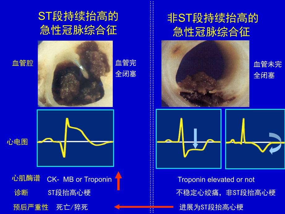 《急性心肌梗死》优质课件_第3页